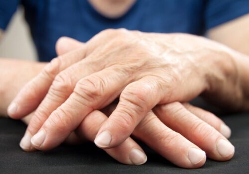 Hands of a woman with rheumatoid arthritis