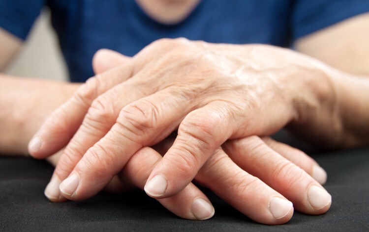 Hands of a woman with rheumatoid arthritis