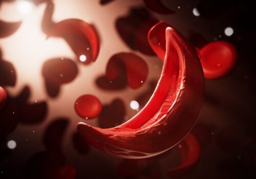 Sickle cell anemia, blood vessel, human anatomy biology - stock photo