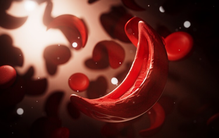 Sickle cell anemia, blood vessel, human anatomy biology - stock photo