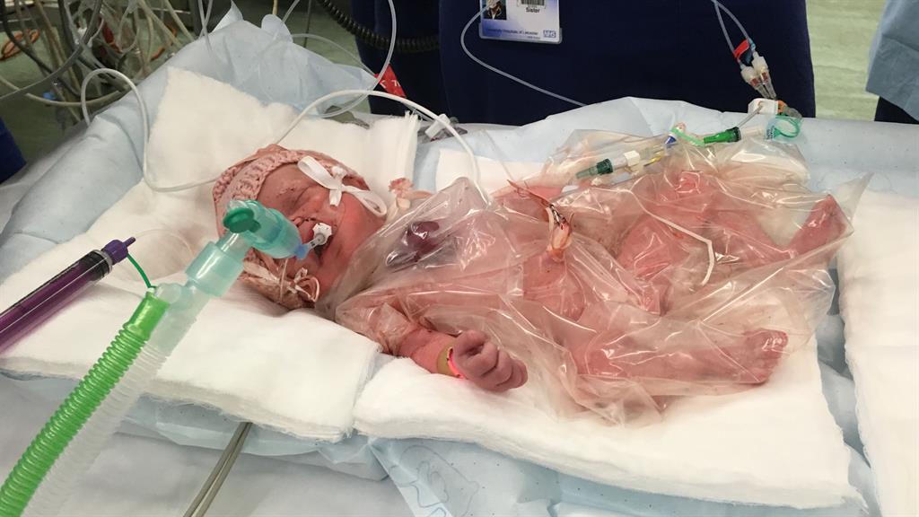 Battling Baby Vanellope in an incubator with her little heart just visible