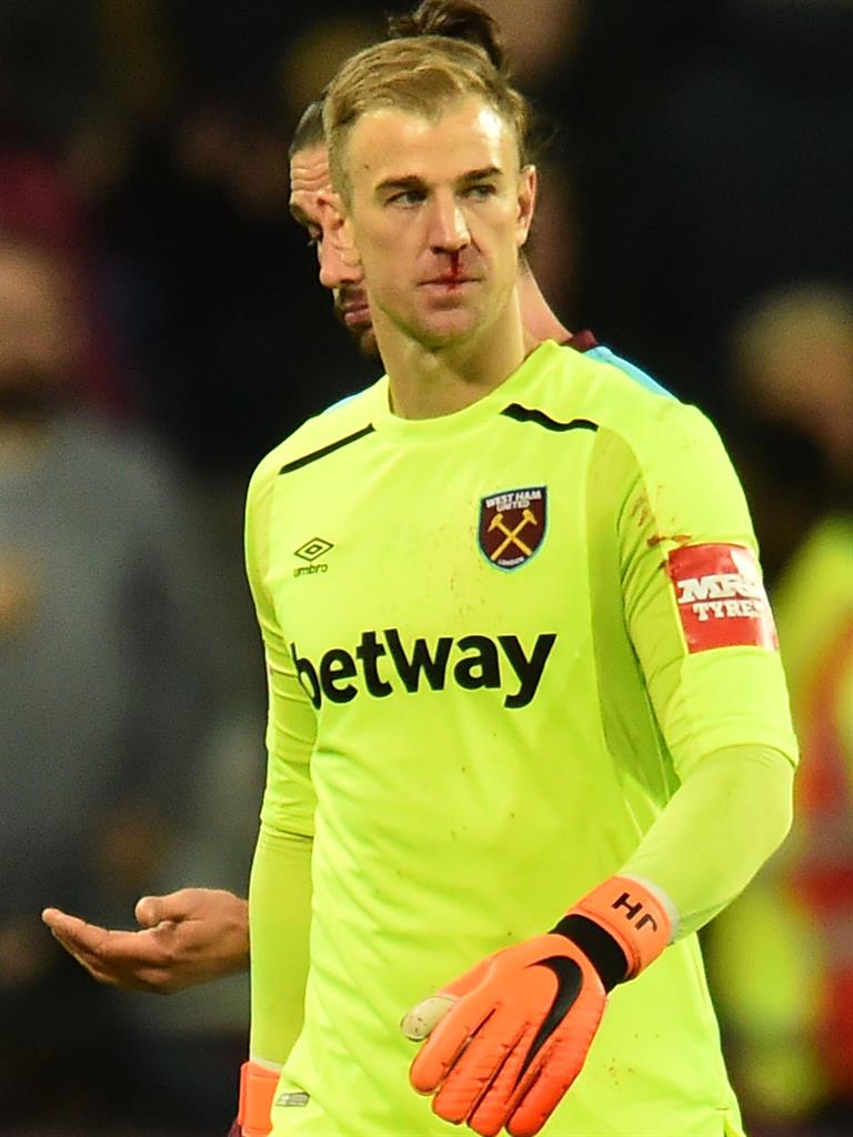 Bloodied: Hart took a blow to the nose in last night's encounter PICTURE: GETTY