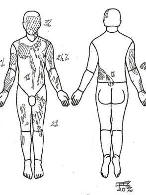 Extensive injuries: A graphic of the burns to van Dongen's body