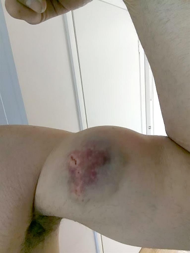 Damage done: Bite marks on Damian's arm PICTURE: SWNS