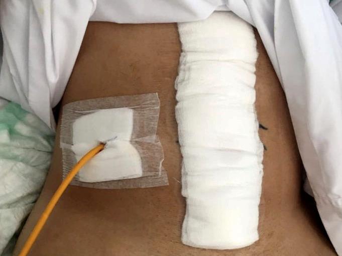 Holiday memory: Dominic's operation scar