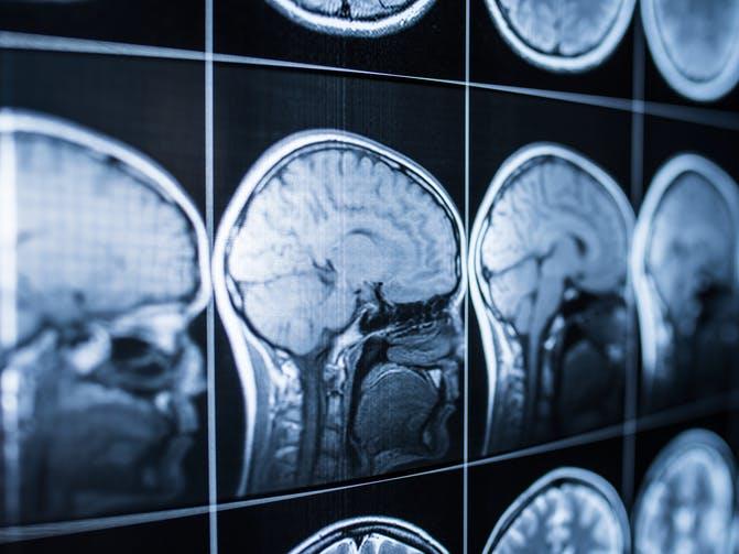 Explanations for the phenomenon: Endorphins, natural DMT, lack of oxygen and brain malfunctions