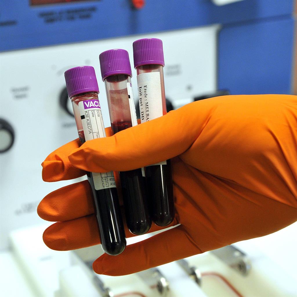 Simple Home Urine Test Could Revolutionize Diagnosis of Prostate Cancer
