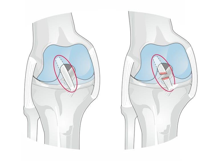 That's torn it: Cruciate ligament injuries are common in footballers PICTURES: SHUTTERSTOCK