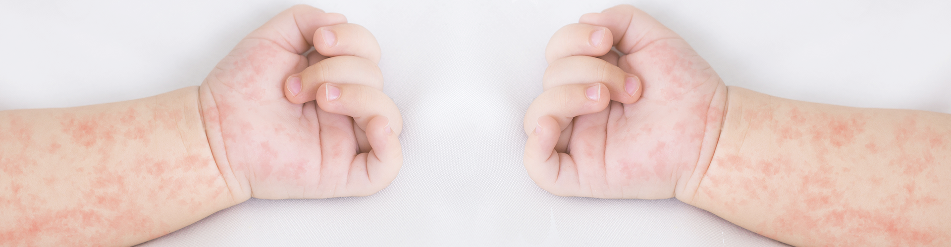 don't ignore your allergy symptoms - baby with rash on arm