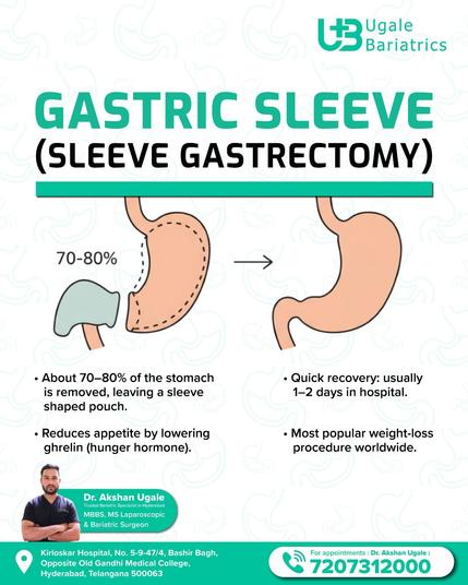 Infographic explaining gastric sleeve surgery: 70–80% of the stomach is removed, creating a sleeve shape. Benefits include reduced appetite, short hospital stay, and effective weight-loss.