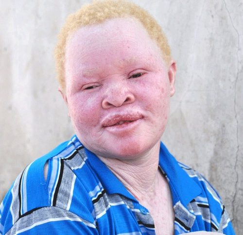 Albino group demands law to provide free access to sunscreens