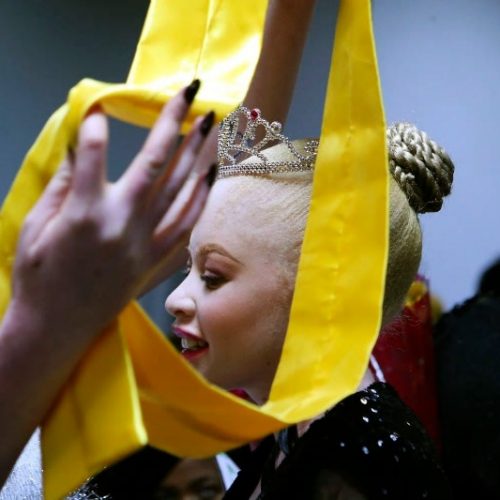 Albinism pageant in Zimbabwe joyfully breaks down prejudice