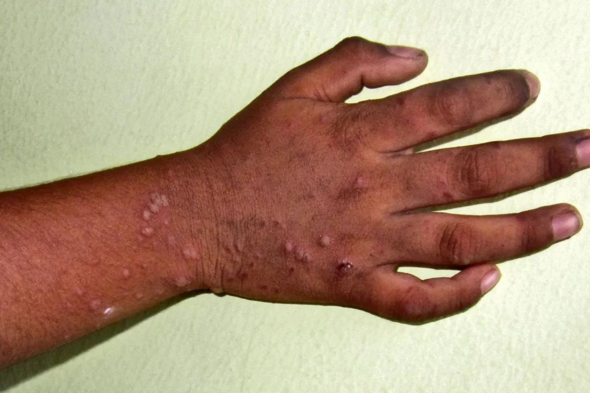 Harare records over 500 cases of hand, foot and mouth disease