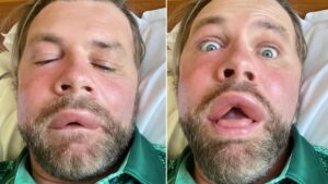 Brian McFadden reveals ‘horrific’ allergic reaction after bee sting